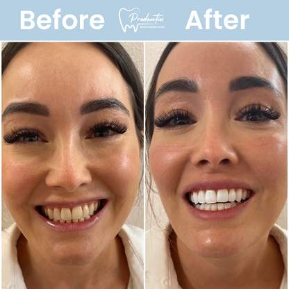 Prodentix Teeth Whitening Pen