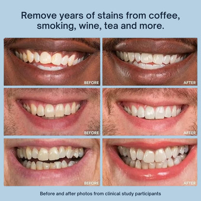 Prodentix Teeth Whitening Pen